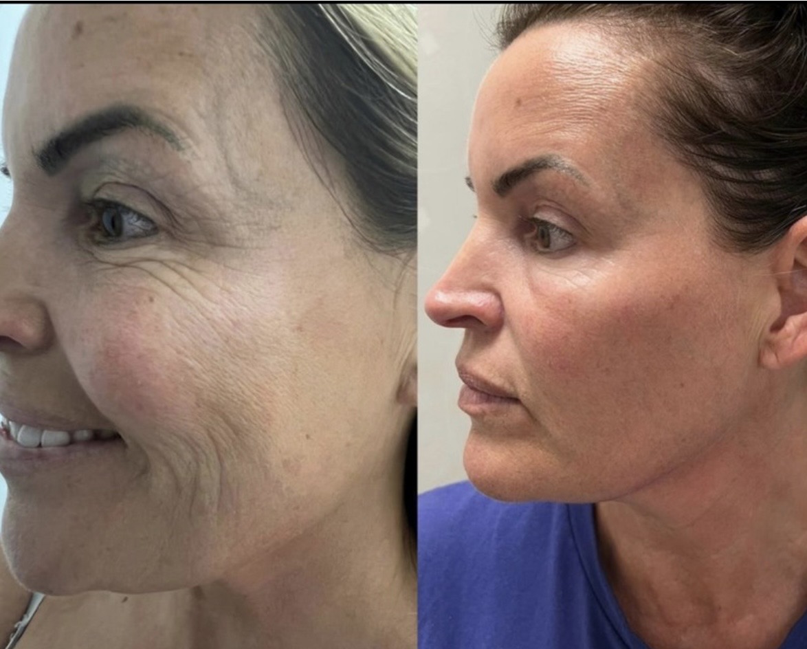Skin booster before and after result