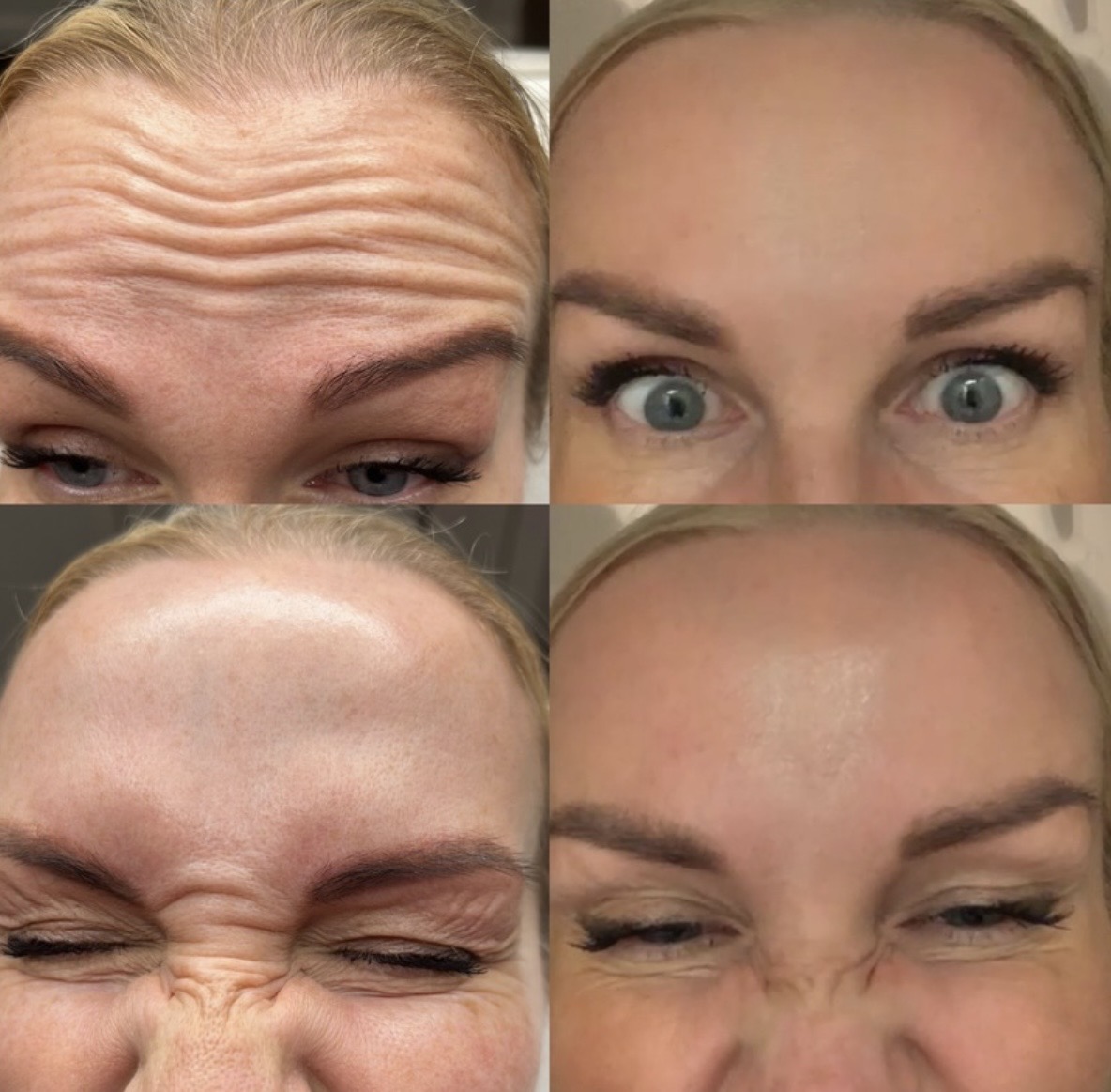 Anti-wrinkle before and after result